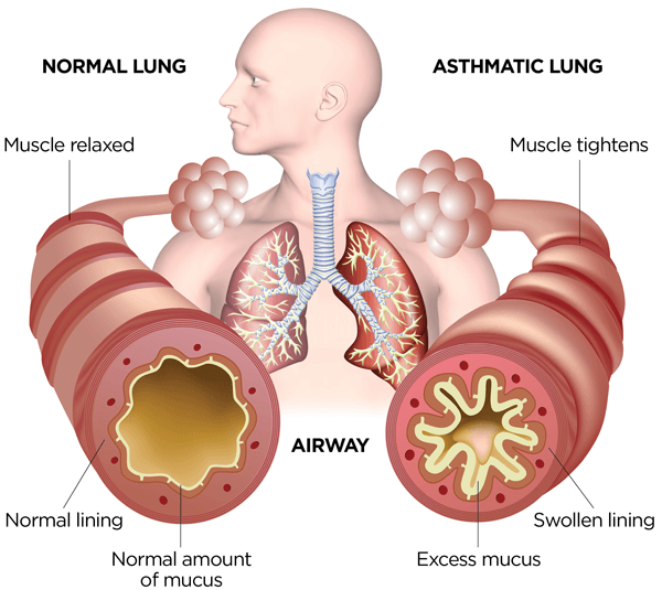 normal vs asthma lung
